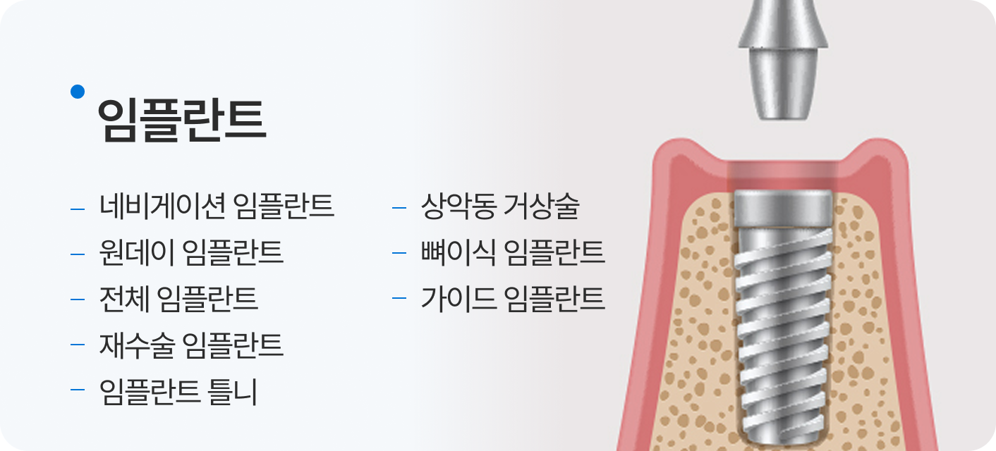 임플란트, 네비게이션 임플란트, 원데이 임플란트, 전체 임플란트, 재수술 임플란트, 임플란트 틀니