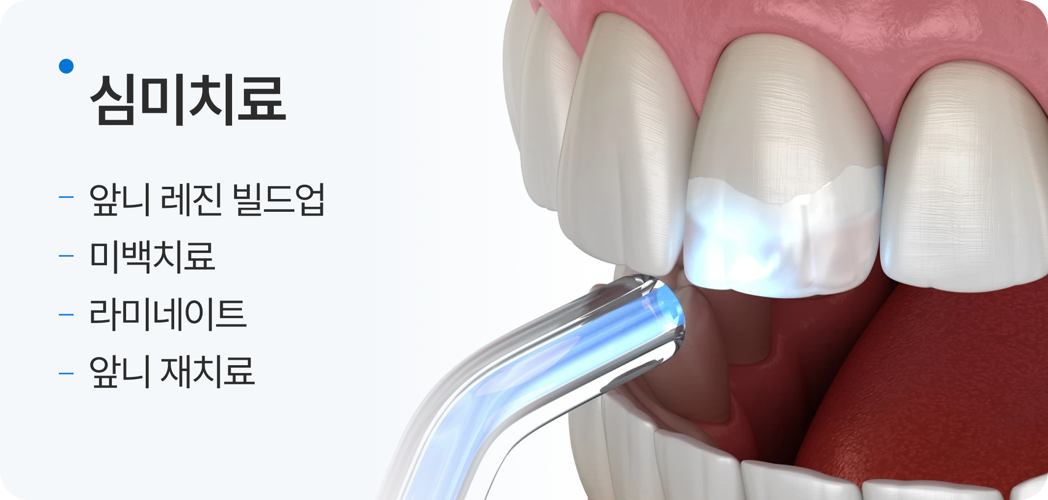임플란트, 네비게이션 임플란트, 원데이 임플란트, 전체 임플란트, 재수술 임플란트, 임플란트 틀니